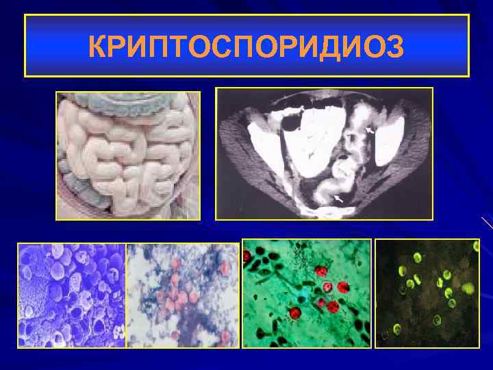 КРИПТОСПОРИДИОЗ 