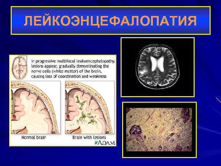 ЛЕЙКОЭНЦЕФАЛОПАТИЯ 