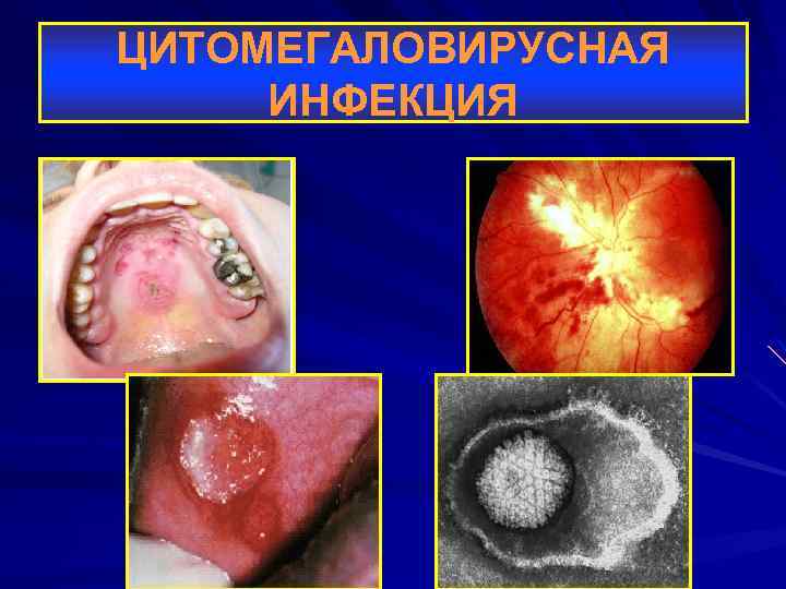ЦИТОМЕГАЛОВИРУСНАЯ ИНФЕКЦИЯ 