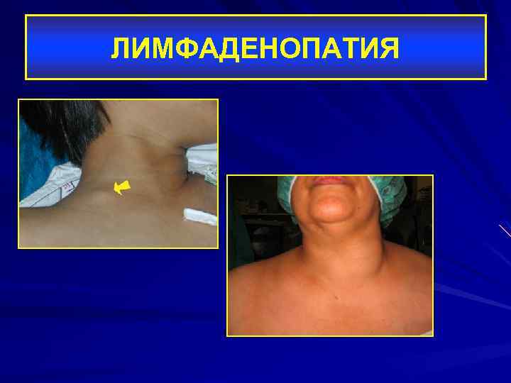 ЛИМФАДЕНОПАТИЯ 