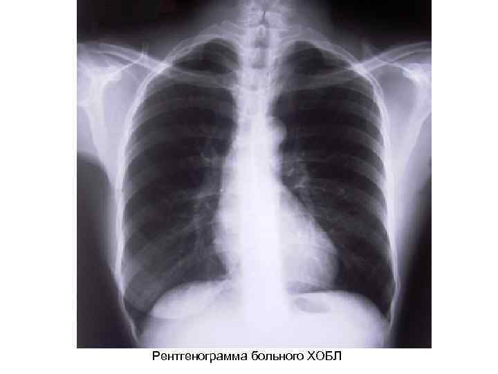 Рентгенограмма больного ХОБЛ 