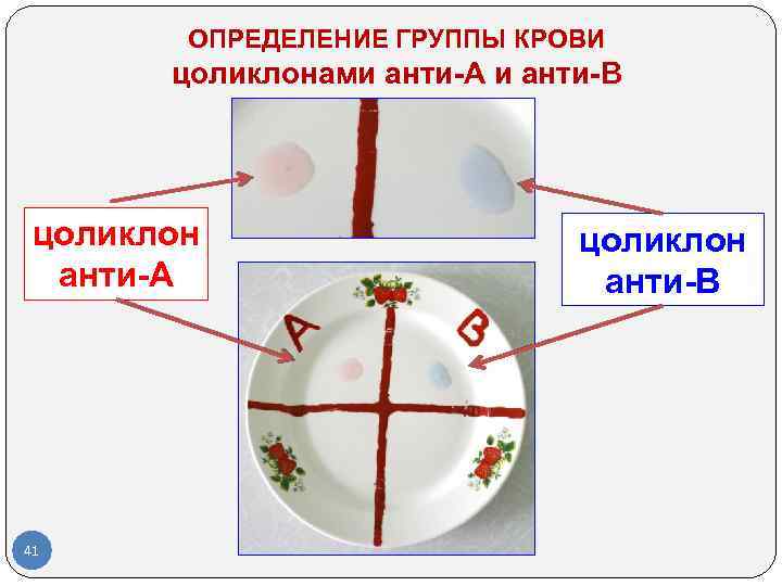 ОПРЕДЕЛЕНИЕ ГРУППЫ КРОВИ цоликлонами анти-А и анти-В цоликлон анти-А 41 цоликлон анти-В 