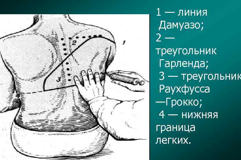 1 — линия Дамуазо; 2— треугольник Гарленда; 3 — треугольник Раухфусса —Грокко; 4 —