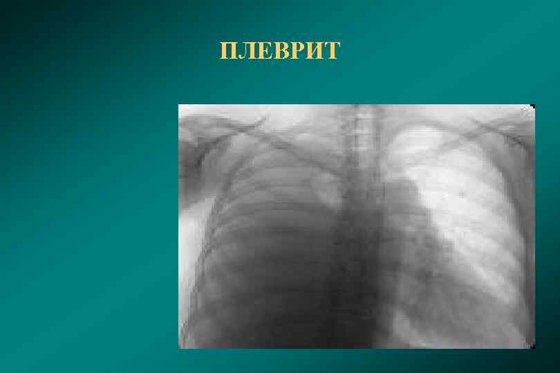 ПЛЕВРИТ 