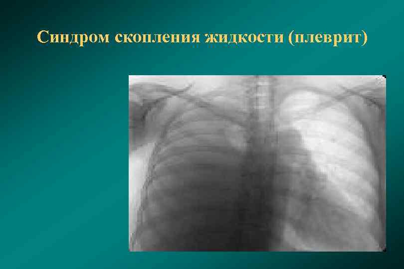 Синдром скопления жидкости (плеврит) 