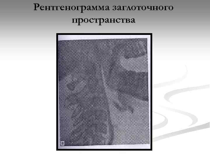 Рентгенограмма заглоточного пространства 