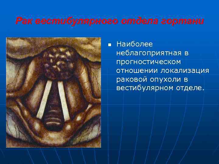 Рак вестибулярного отдела гортани n Наиболее неблагоприятная в прогностическом отношении локализация раковой опухоли в