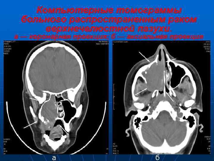 Компьютерные томограммы больного распространенным раком верхнечелюстной пазухи. а — коронарная проекция; б — аксиальная