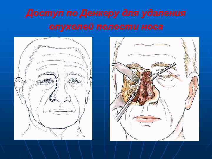 Доступ по Денкеру для удаления опухолей полости носа 