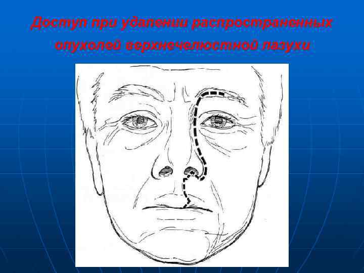 Доступ при удалении распространенных опухолей верхнечелюстной пазухи 