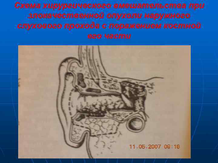 Схема хирургического вмешательства при злокачественной опухоли наружного слухового прохода с поражением костной его части