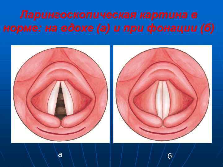 Ларингоскопическая картина в норме: на вдохе (а) и при фонации (б) а б 