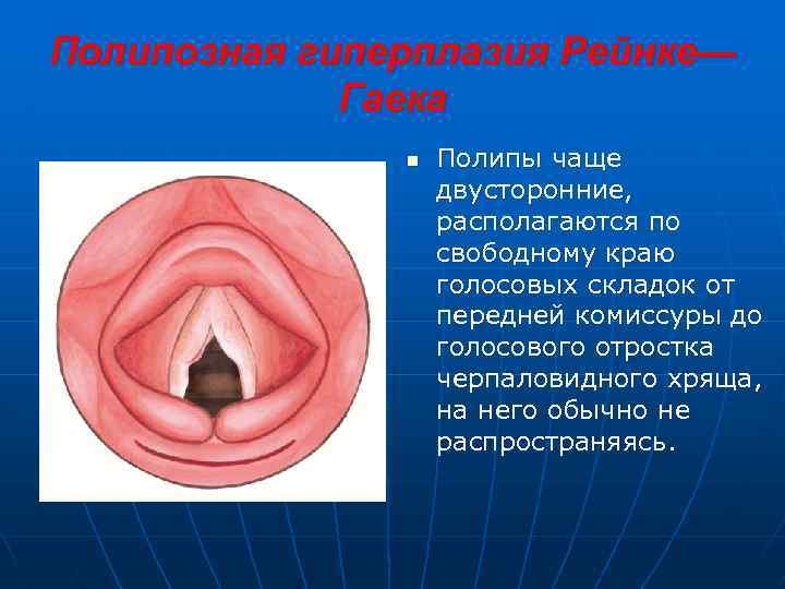 Полипозная гиперплазия Рейнке— Гаека n Полипы чаще двусторонние, располагаются по свободному краю голосовых складок