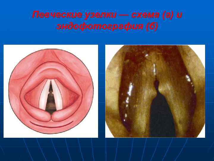 Певческие узелки — схема (а) и эндофотография (б) 