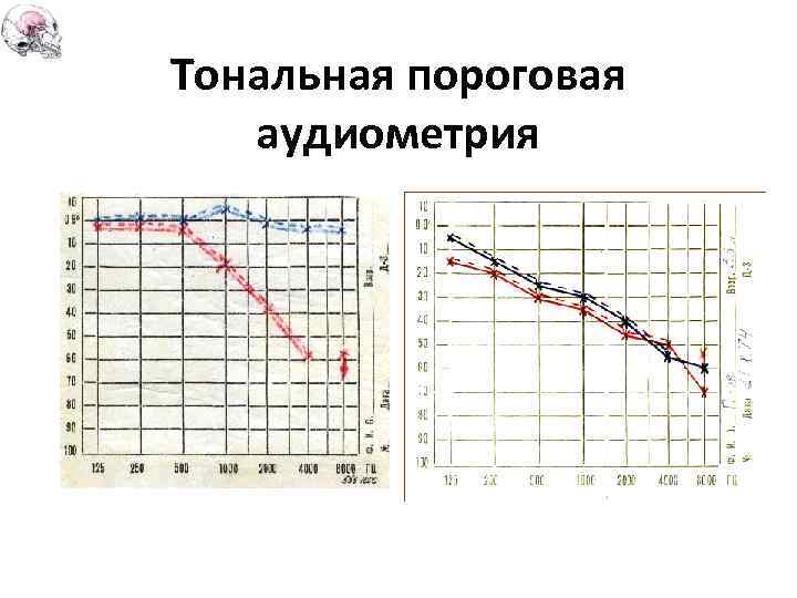 Тональная пороговая аудиометрия 