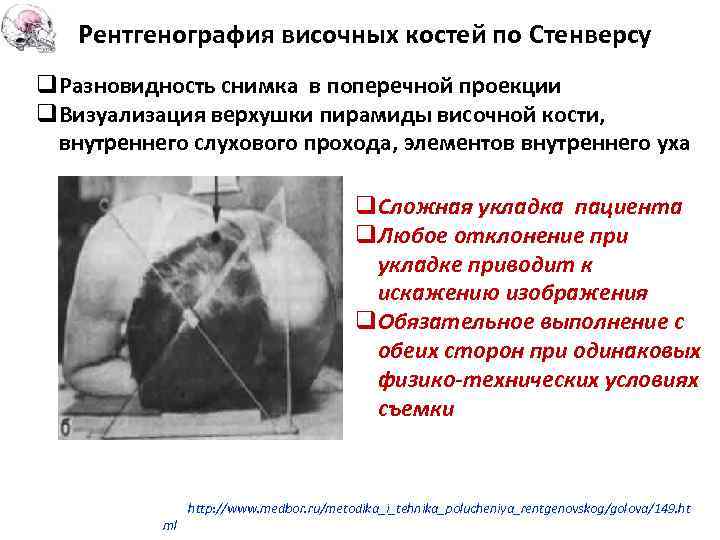 Рентгенография височных костей по Стенверсу q. Разновидность снимка в поперечной проекции q. Визуализация верхушки