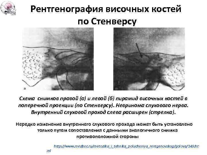 Рентгенография височных костей по Стенверсу Схема снимков правой (а) и левой (б) пирамид височных