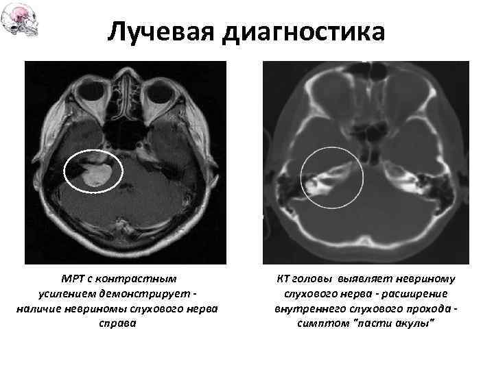 Лучевая диагностика МРТ с контрастным усилением демонстрирует - наличие невриномы слухового нерва справа КТ
