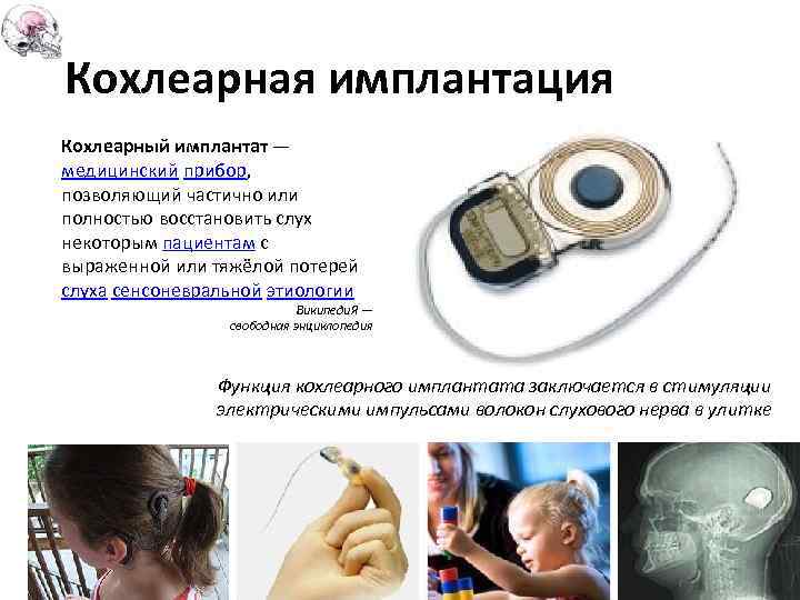 Кохлеарная имплантация Кохлеарный имплантат — медицинский прибор, позволяющий частично или полностью восстановить слух некоторым