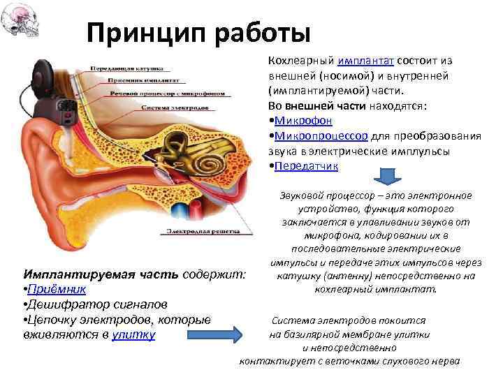 Схема работы кохлеарного импланта