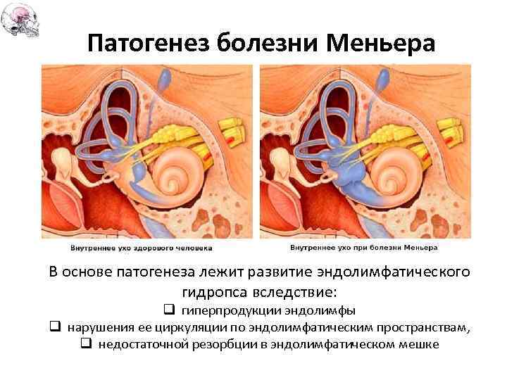 Патогенез болезни Меньера В основе патогенеза лежит развитие эндолимфатического гидропса вследствие: q гиперпродукции эндолимфы