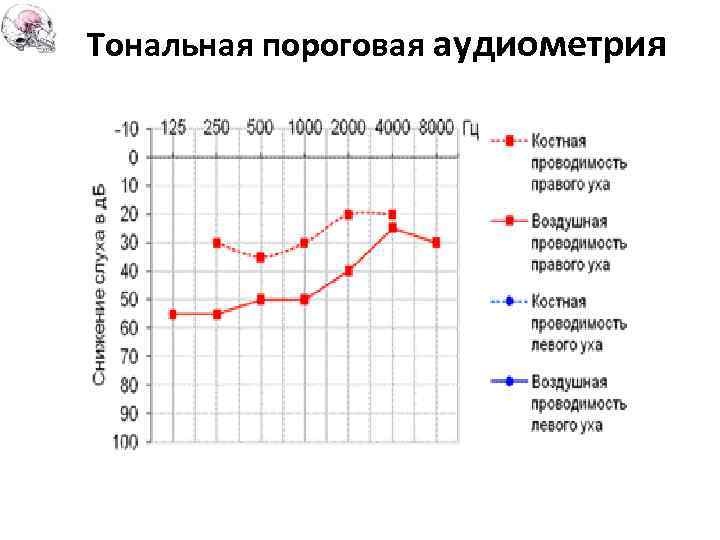 Тональная пороговая аудиометрия 