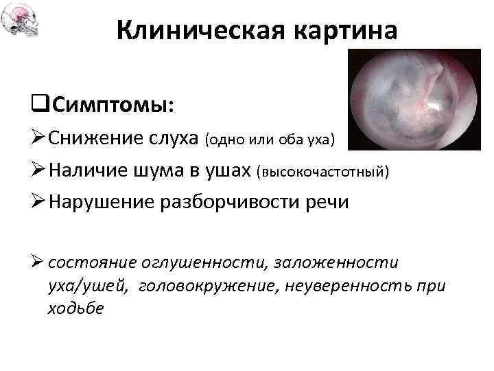 Клиническая картина q. Симптомы: Ø Снижение слуха (одно или оба уха) Ø Наличие шума