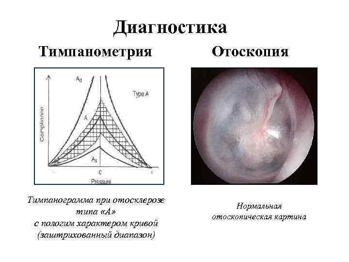 Диагностика Тимпанометрия Тимпанограмма при отосклерозе типа «А» с пологим характером кривой (заштрихованный диапазон) Отоскопия