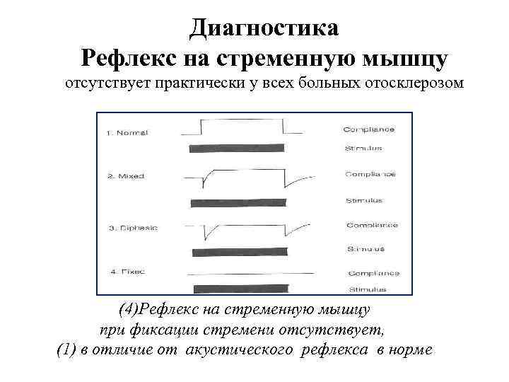 Диагностика Рефлекс на стременную мышцу отсутствует практически у всех больных отосклерозом (4)Рефлекс на стременную