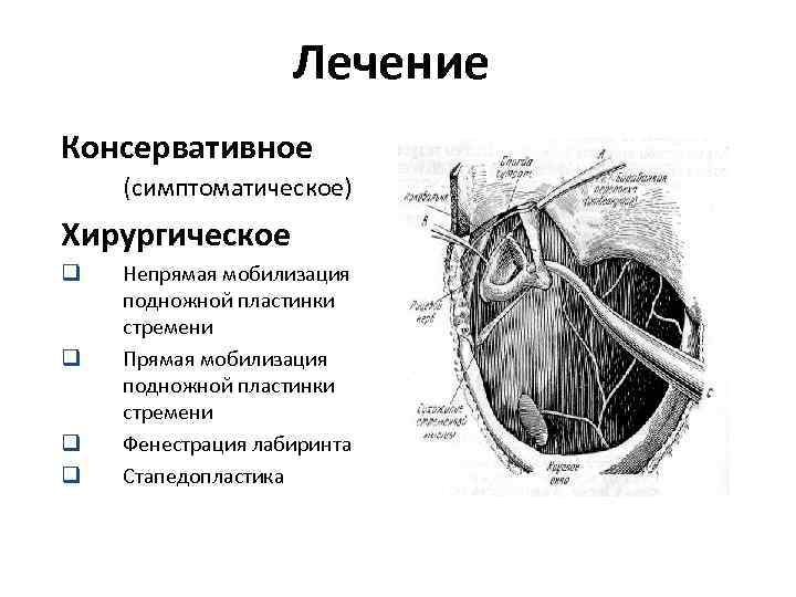 Лечение Консервативное (симптоматическое) Хирургическое q q Непрямая мобилизация подножной пластинки стремени Прямая мобилизация подножной