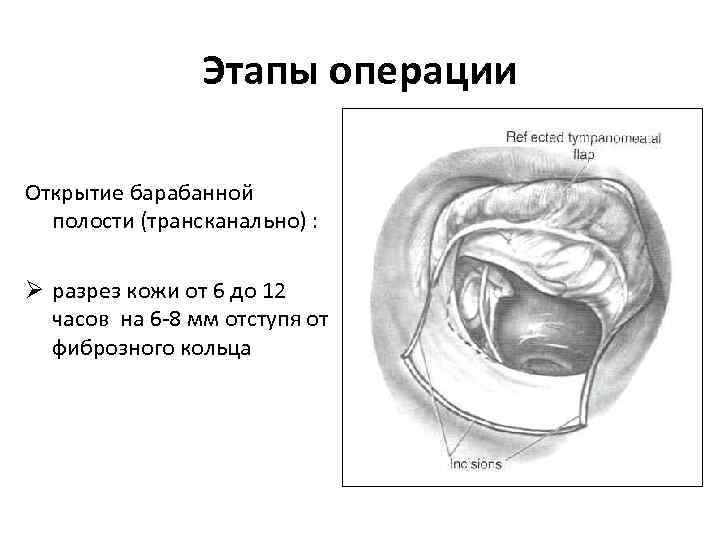 Этапы операции Открытие барабанной полости (трансканально) : Ø разрез кожи от 6 до 12