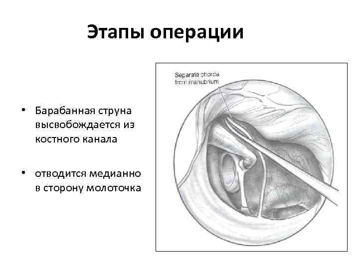 Этапы операции • Барабанная струна высвобождается из костного канала • отводится медианно в сторону