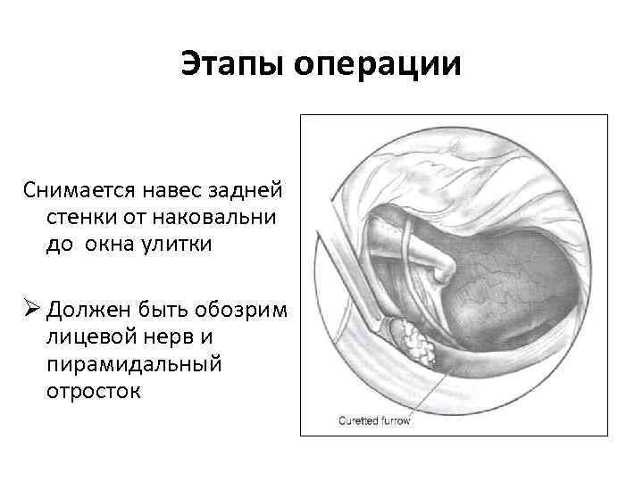 Этапы операции Снимается навес задней стенки от наковальни до окна улитки Ø Должен быть