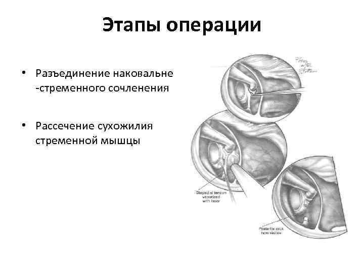 Этапы операции • Разъединение наковальне -стременного сочленения • Рассечение сухожилия стременной мышцы 