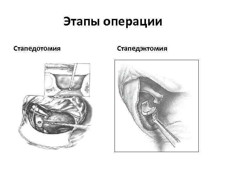 Этапы операции Стапедотомия Стапедэктомия 