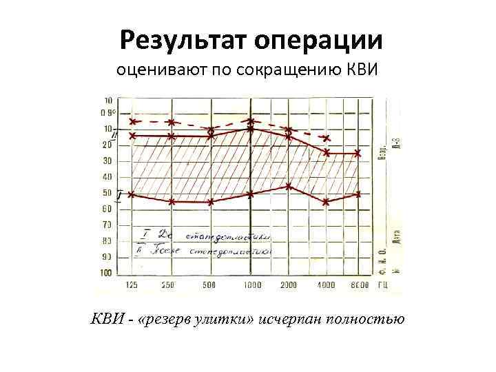 Результат операции оценивают по сокращению КВИ - «резерв улитки» исчерпан полностью 