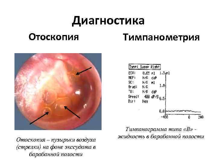 Диагностика Отоскопия – пузырьки воздуха (стрелки) на фоне экссудата в барабанной полости Тимпанометрия Тимпанограмма