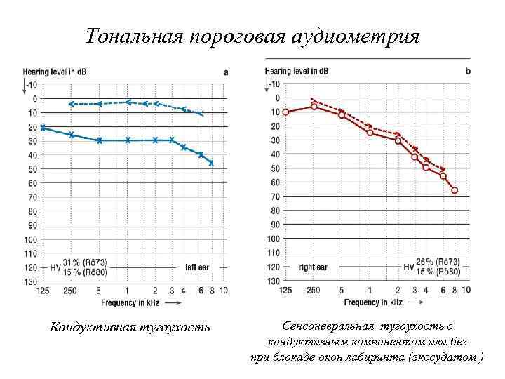 Тональная пороговая аудиометрия Кондуктивная тугоухость Сенсоневральная тугоухость с кондуктивным компонентом или без при блокаде