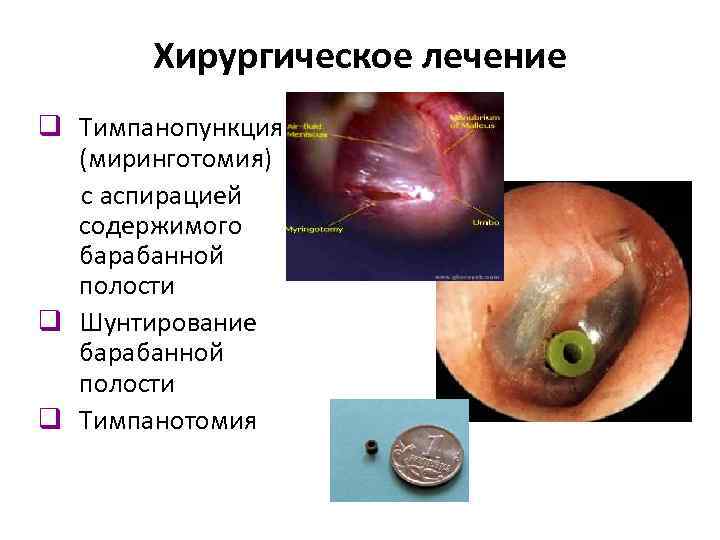 Хирургическое лечение q Тимпанопункция (миринготомия) с аспирацией содержимого барабанной полости q Шунтирование барабанной полости