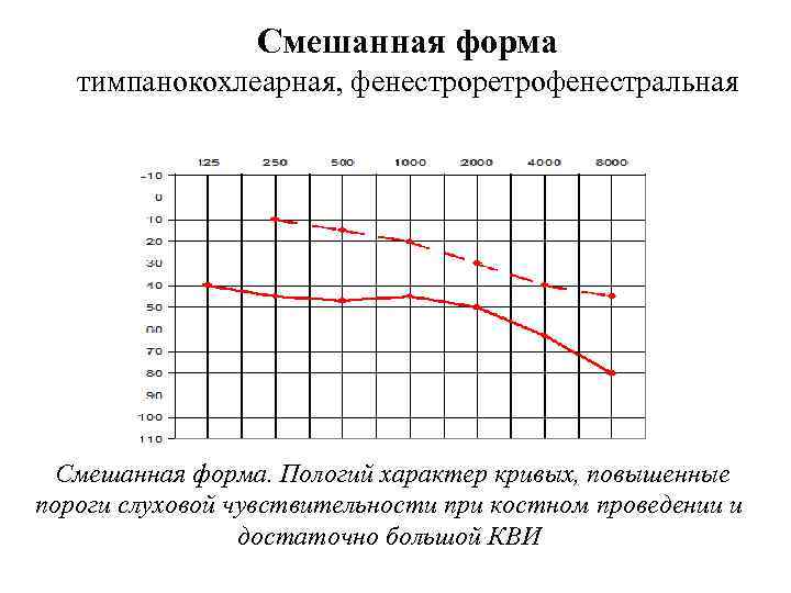 Смешанная форма тимпанокохлеарная, фенестроретрофенестральная Смешанная форма. Пологий характер кривых, повышенные пороги слуховой чувствительности при