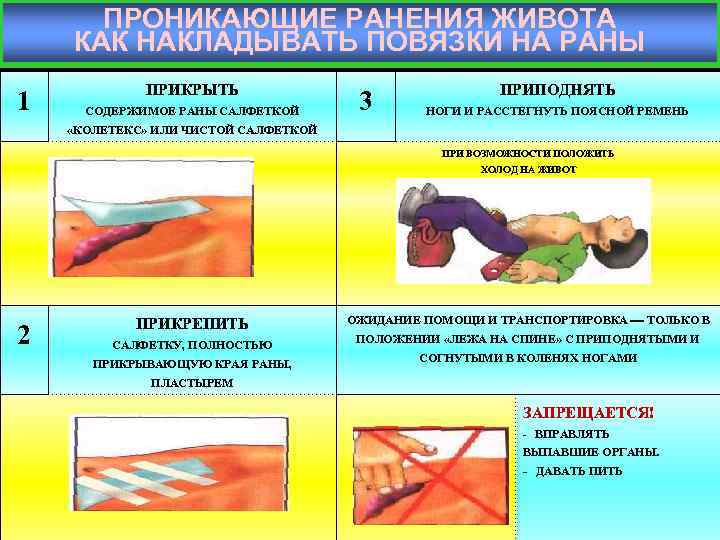 ПРОНИКАЮЩИЕ РАНЕНИЯ ЖИВОТА КАК НАКЛАДЫВАТЬ ПОВЯЗКИ НА РАНЫ 1 ПРИКРЫТЬ СОДЕРЖИМОЕ РАНЫ САЛФЕТКОЙ 3