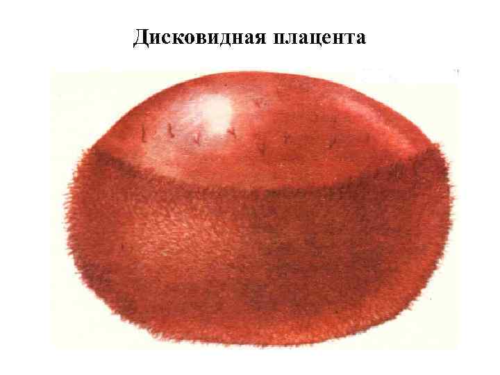 Дисковидная плацента 