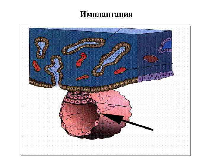 Имплантация 