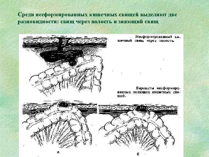 Среди несформированных кишечных свищей выделяют две разновидности: свищ через полость и зияющий свищ 