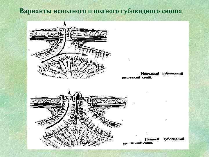 Варианты неполного и полного губовидного свища 