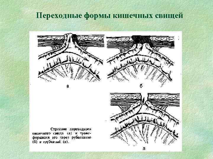 Переходные формы кишечных свищей 