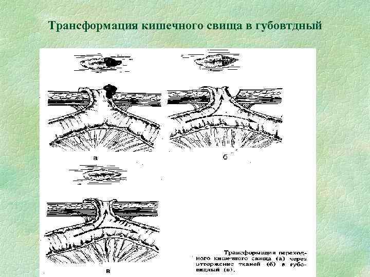 Трансформация кишечного свища в губовтдный 