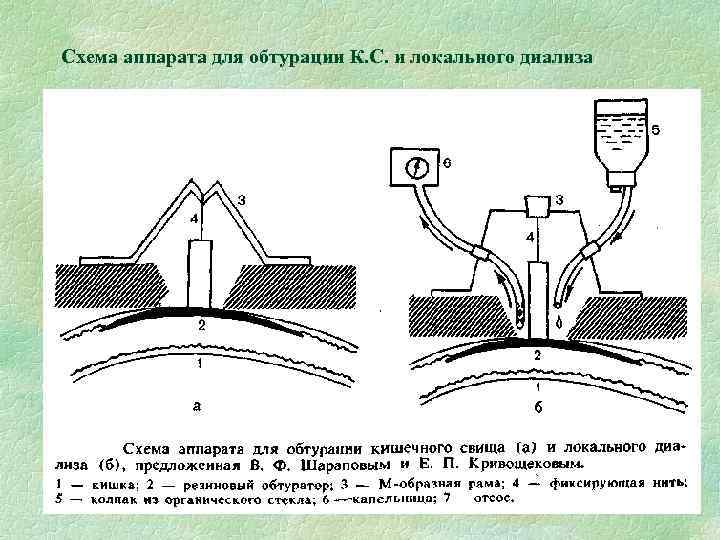 Схема аппарата для обтурации К. С. и локального диализа 