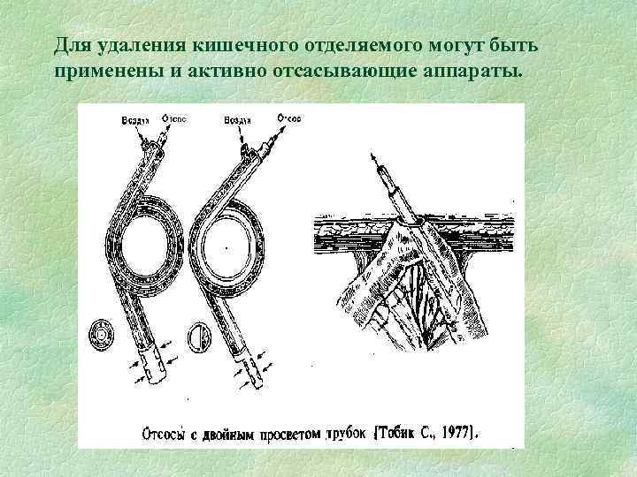 Для удаления кишечного отделяемого могут быть применены и активно отсасывающие аппараты. 