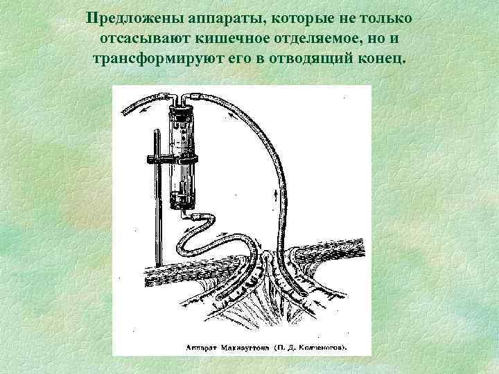 Кишечные свищи презентация госпитальная хирургия